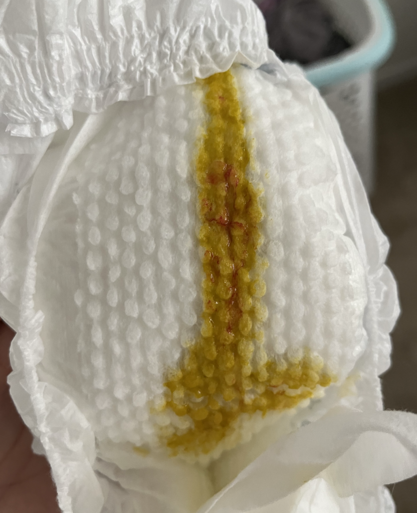 hyperlactation diaper